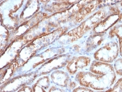 IHC staining of FFPE human renal cell carcinoma with HSP60 antibody (clone AE-1). HIER: boil tissue sections in pH 9 10mM Tris with 1mM EDTA for 20 min and allow to cool before testing.