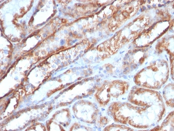 IHC staining of FFPE human renal cell carcinoma with HSP60 antibody (clone AE-1). HIER: boil tissue section