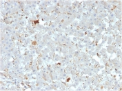 IHC staining of FFPE human liver carcinoma with APOAIV antibody. HIER: boil tissue sections in pH 9 10mM Tris with 1mM EDTA for 20 min and allow to cool before testing.