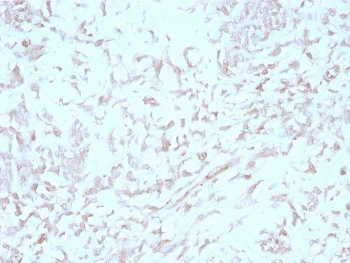 IHC staining of FFPE human liver with Kindlin-1 antibody (clone 4A5.14). HIER: boil tissue sections in pH 9 10mM Tris with 1mM EDTA for 20 min and allow to cool before testing.~
