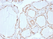 IHC staining of FFPE human thyroid carcinoma with Thyroid Peroxidase antibody. HIER: boil tissue sections in pH 9 10mM Tris with 1mM EDTA for 20 min and allow to cool before testing.
