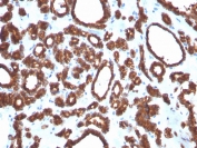 IHC staining of FFPE human thyroid carcinoma with TPO antibody. HIER: boil tissue sections in pH 9 10mM Tris with 1mM EDTA for 20 min and allow to cool before testing.