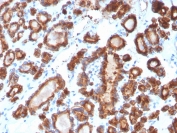 IHC staining of FFPE human thyroid carcinoma with TPO antibody. HIER: boil tissue sections in pH 9 10mM Tris with 1mM EDTA for 20 min and allow to cool before testing.