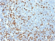 IHC staining of FFPE human lymphoma with recombinant ZAP70 antibody. HIER: boil tissue sections in pH 9 10mM Tris with 1mM EDTA for 20 min and allow to cool before testing.