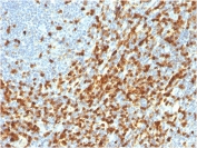 IHC staining of FFPE human lymphoma with recombinant ZAP70 antibody. HIER: boil tissue sections in pH 9 10mM Tris with 1mM EDTA for 20 min and allow to cool before testing.