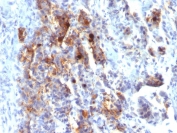 IHC staining of FFPE human gastric carcinoma with biotinylated MUC5AC antibody (clone 45M1). HIER: boil tissue sections in pH 9 10mM Tris with 1mM EDTA for 20 min and allow to cool before testing.