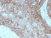 IHC staining of FFPE human breast carcinoma with recombinant PD-L1 antibody (clone rPDL1/4772). HIER: boil tissue sections in pH 9 10mM Tris with 1mM EDTA for 20 min and allow to cool before testing.