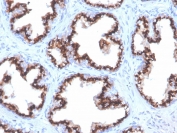 IHC staining of FFPE human prostate carcinoma with recombinant Prostein antibody (clone ZR9). HIER: boil tissue sections in pH 9 10mM Tris with 1mM EDTA for 20 min and allow to cool before testing.