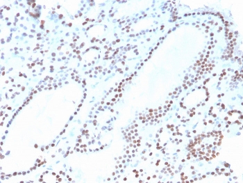IHC staining of FFPE human thyroid with recombinant PAX8 antibody. HIER: boil tissue sections in pH 9 10mM Tris with 1mM EDTA for 20 min and allow to cool before testing.~