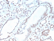 IHC staining of FFPE human thyroid with recombinant PAX8 antibody. HIER: boil tissue sections in pH 9 10mM Tris with 1mM EDTA for 20 min and allow to cool before testing.