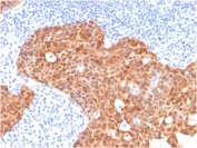 IHC staining of FFPE human cervix with p16INK4a antibody (clone CDKN2A/4499). HIER: boil tissue sections in pH 9 10mM Tris with 1mM EDTA for 20 min and allow to cool before testing.