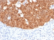 IHC staining of FFPE human cervix with p16INK4a antibody (clone CDKN2A/4499). HIER: boil tissue sections in pH 9 10mM Tris with 1mM EDTA for 20 min and allow to cool before testing.