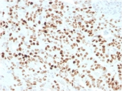 IHC staining of FFPE human colon carcinoma with recombinant p21 antibody (clone CIP1/4377R). HIER: boil tissue sections in pH 9 10mM Tris with 1mM EDTA for 20 min and allow to cool before testing.