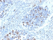IHC staining of FFPE human lung carcinoma with recombinant p21 antibody (clone CIP1/4377R). HIER: boil tissue sections in pH 9 10mM Tris with 1mM EDTA for 20 min and allow to cool before testing.