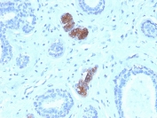 HC staining of FFPE human breast carcinoma with Mammaglobin antibody (clone MGB/4056). HIER: boil tissue sections in pH 9 10mM Tris with 1mM EDTA for 20 min and allow to cool before testing.