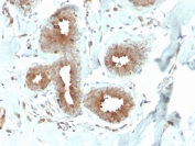 IHC staining of FFPE human breast carcinoma with recombinant Mammaglobin antibody (clone MGB/4057R). HIER: boil tissue sections in pH 9 10mM Tris with 1mM EDTA for 20 min and allow to cool before testing.