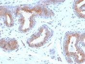 IHC staining of FFPE human breast carcinoma with recombinant Mammaglobin antibody (clone rMGB/4299). HIER: boil tissue sections in pH 9 10mM Tris with 1mM EDTA for 20 min and allow to cool before testing.