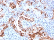 IHC staining of FFPE human thyroid carcinoma with TPO antibody. HIER: boil tissue sections in pH 9 10mM Tris with 1mM EDTA for 20 min and allow to cool before testing.