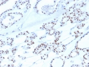 IHC staining of FFPE human thyroid with recombinant PAX8 antibody. HIER: boil tissue sections in pH 9 10mM Tris with 1mM EDTA for 20 min and allow to cool before testing.
