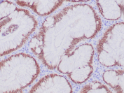 IHC analysis of CDX2 / Caudal type homeobox 2 antibody in human colon adenocarcinoma tissue. Formalin-fixed, paraffin-embedded human colon adenocarcinoma shows strong nuclear HRP-DAB brown chromogenic staining in tumor epithelial cells, consistent with intestinal lineage expression of CDX2, while surrounding stromal elements are negative. Clone CDX2/4394R was used at 2 ug/ml in PBS for 30 min at RT. Heat-induced epitope retrieval was performed by boiling tissue sections in 10mM Tris with 1mM EDTA, pH 9.0, for 45 min at 95oC followed by cooling at RT for 20 minutes.