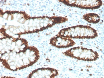 IHC staining of FFPE human colon carcinoma with recombinant CDX2 antibody. HIER: boil tissue sections in pH 9 10mM Tris with 1mM EDTA for 20 min and allow to cool before testing.~