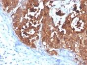 IHC staining of FFPE human colon carcinoma with CEA antibody (clone C66/4098). HIER: boil tissue sections in pH 9 10mM Tris with 1mM EDTA for 20 min and allow to cool before testing.