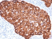 IHC staining of FFPE human breast carcinoma with HER2 antibody (clone ZR5). HIER: boil tissue sections in pH 9 10mM Tris with 1mM EDTA for 20 min and allow to cool before testing.