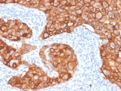 IHC staining of FFPE human breast carcinoma with HER2 antibody (clone ZR5). HIER: boil tissue sections in pH 9 10mM Tris with 1mM EDTA for 20 min and allow to cool before testing.