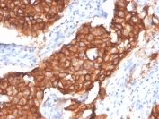 IHC staining of FFPE human breast carcinoma with HER2 antibody (clone ERBB2/4439). HIER: boil tissue sections in pH 9 10mM Tris with 1mM EDTA for 20 min and allow to cool before testing.