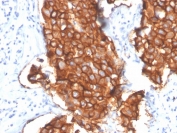 IHC staining of FFPE human breast carcinoma with HER2 antibody (clone ERBB2/4439R). HIER: boil tissue sections in pH 9 10mM Tris with 1mM EDTA for 20 min and allow to cool before testing.