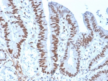 IHC staining of FFPE human colon carcinoma with recombinant MSH6 antibody (clone rMSH6/4743). HIER: boil tissue sections in pH 9 10mM Tris with 1mM EDTA for 20 min and allow to cool before testing.~