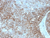 IHC staining of FFPE human lung small cell carcinoma with recombinant PD-L1 antibody (clone PDL1/4280R). HIER: boil tissue sections in pH 9 10mM Tris with 1mM EDTA for 20 min and allow to cool before testing.