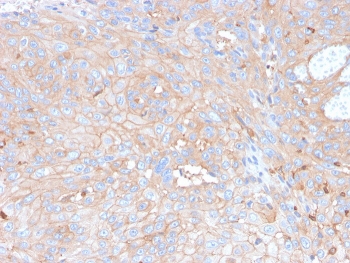 IHC staining of FFPE human skin with recombinant PDL1 antibody (clone rPDL1/4773). HIER: boil tissue sections in pH 9 10mM Tris with 1mM EDTA for 20 min and allow to cool before testing.