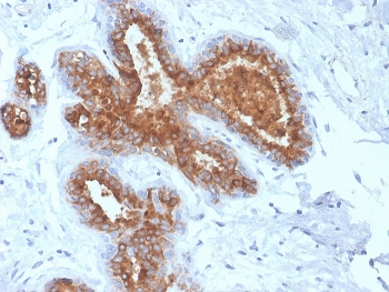 IHC staining of FFPE human breast carcinoma with recombinant MUC1 antibody. HIER: boil tissue sections in pH 9 10mM Tris with 1mM EDTA for 20 min and allow to cool before testing.~