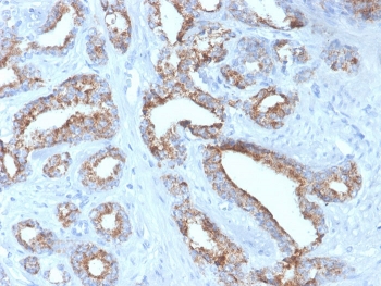 IHC staining of FFPE human prostate carcinoma with recombinant AMACR antibody (clone rAMACR/4674). HIER: boil tissue sections in pH 9 10mM Tris with 1mM EDTA for 20 min and allow to cool before testing.~