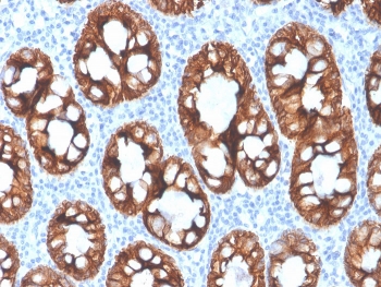 IHC staining of FFPE human colon with recombinant Cytokeratin 8 antibody (clone rKRT8/4209). HIER: boil tissue sections in pH 9 10mM Tris with 1mM EDTA for 20 min and allow to cool before testing.~