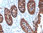 IHC staining of FFPE human colon carinoma with recombinant EpCAM antibody (clone EGP40/4546R). HIER: boil tissue sections in pH 9 10mM Tris with 1mM EDTA for 20 min and allow to cool before testing.