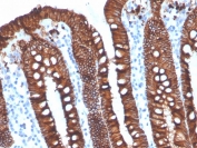 IHC staining of FFPE human ovarian carinoma with recombinant EpCAM antibody (clone EGP40/4546R). HIER: boil tissue sections in pH 9 10mM Tris with 1mM EDTA for 20 min and allow to cool before testing.