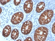 IHC staining of FFPE human colon carinoma with recombinant EpCAM antibody (clone rEGP40/4547). HIER: boil tissue sections in pH 9 10mM Tris with 1mM EDTA for 20 min and allow to cool before testing.