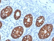 IHC staining of FFPE human colon carinoma with recombinant EpCAM antibody (clone rEGP40/4547). HIER: boil tissue sections in pH 9 10mM Tris with 1mM EDTA for 20 min and allow to cool before testing.