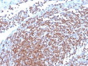 IHC staining of FFPE human mantle cell carcinoma with recombinant Cyclin D1 antibody (clone CCND1/3370R). HIER: boil tissue sections in pH 9 10mM Tris with 1mM EDTA for 20 min and allow to cool before testing.