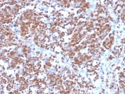 IHC staining of FFPE human mantle cell carcinoma with recombinant Cyclin D1 antibody (clone CCND1/3370R). HIER: boil tissue sections in pH 9 10mM Tris with 1mM EDTA for 20 min and allow to cool before testing.