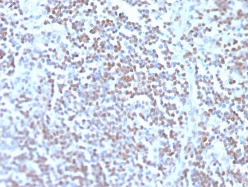 IHC staining of FFPE human mantle cell carcinoma with recombinant Cyclin D1 antibody (clone rCCND1/4752). HIER: boil tissue sections in pH 9 10mM Tris with 1mM EDTA for 20 min and allow to cool before testing.~