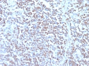 IHC staining of FFPE human mantle cell carcinoma with recombinant Cyclin D1 antibody (clone rCCND1/4752). HIER: boil tissue sections in pH 9 10mM Tris with 1mM EDTA for 20 min and allow to cool before testing.