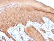 IHC staining of FFPE human colon carcinoma with recombinant Type I Cytokeratin antibody (clone KRTH/4440R). HIER: boil tissue sections in pH 9 10mM Tris with 1mM EDTA for 20 min and allow to cool before testing.