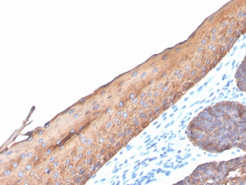 IHC staining of FFPE human colon carcinoma with recombinant Type I Cytokeratin antibody (clone KRTH/4440R). HIER: boil tissue sections in pH 9 10mM Tris with 1mM EDTA for 20 min and allow to cool before testing.~