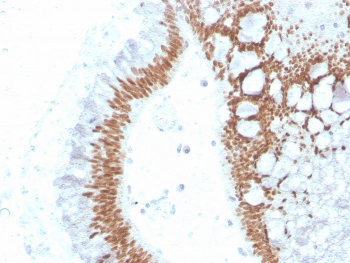 IHC staining of FFPE human colon carcinoma with recombinant SATB2 antibody (clone SATB2/4374R). HIER: boil tissue sections in pH 9 10mM Tris with 1mM EDTA for 20 min and allow to cool before testing.~