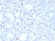 IHC staining of FFPE human breast carcinoma with Estrogen Receptor beta 1 antibody (clone PGP5/10). HIER: boil tissue sections in pH 9 10mM Tris with 1mM EDTA for 20 min and allow to cool before testing.