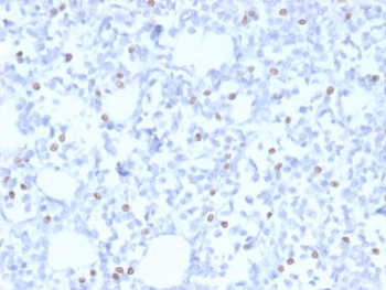 IHC staining of FFPE human breast with Estrogen Receptor beta 5 antibody (clone PPG5/25). HIER: boil tissue sections in pH 9 10mM Tris with 1mM EDTA for 20 min and allow to cool before testing.~