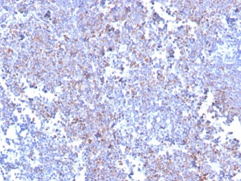 IHC staining of FFPE human mantle cell lymphoma with recombinant SOX11 antibody (clone SOX11/3235R). HIER: boil tissue sections in pH 9 10mM Tris with 1mM EDTA for 20 min and allow to cool before testing.~